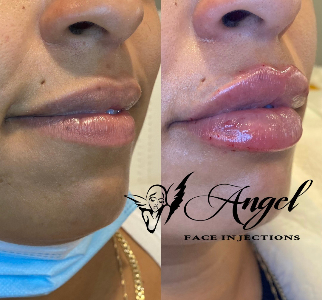 Dermal Fillers by Angel Face Injections