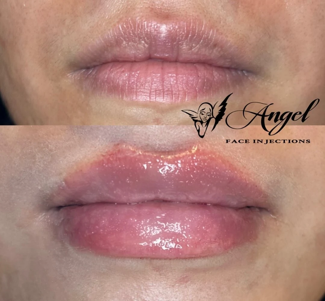 Lip Fillers by Angel Face Injections