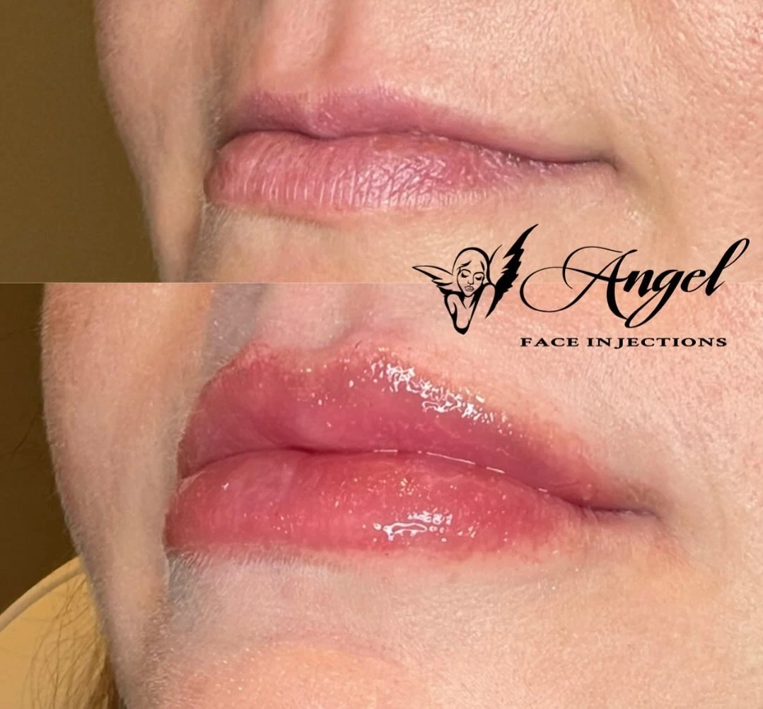 Lip Fillers by Angel Face Injections