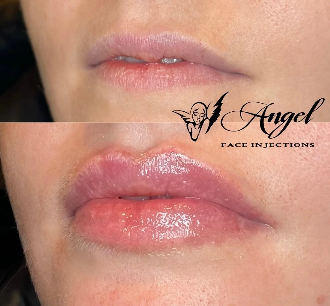 Lip Fillers in Boston, MA