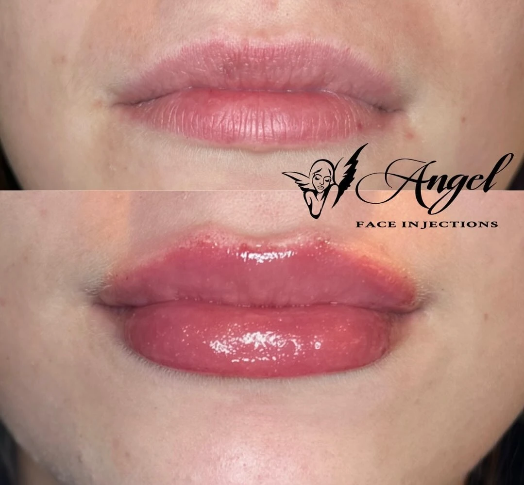 Lip Fillers in Boston, MA