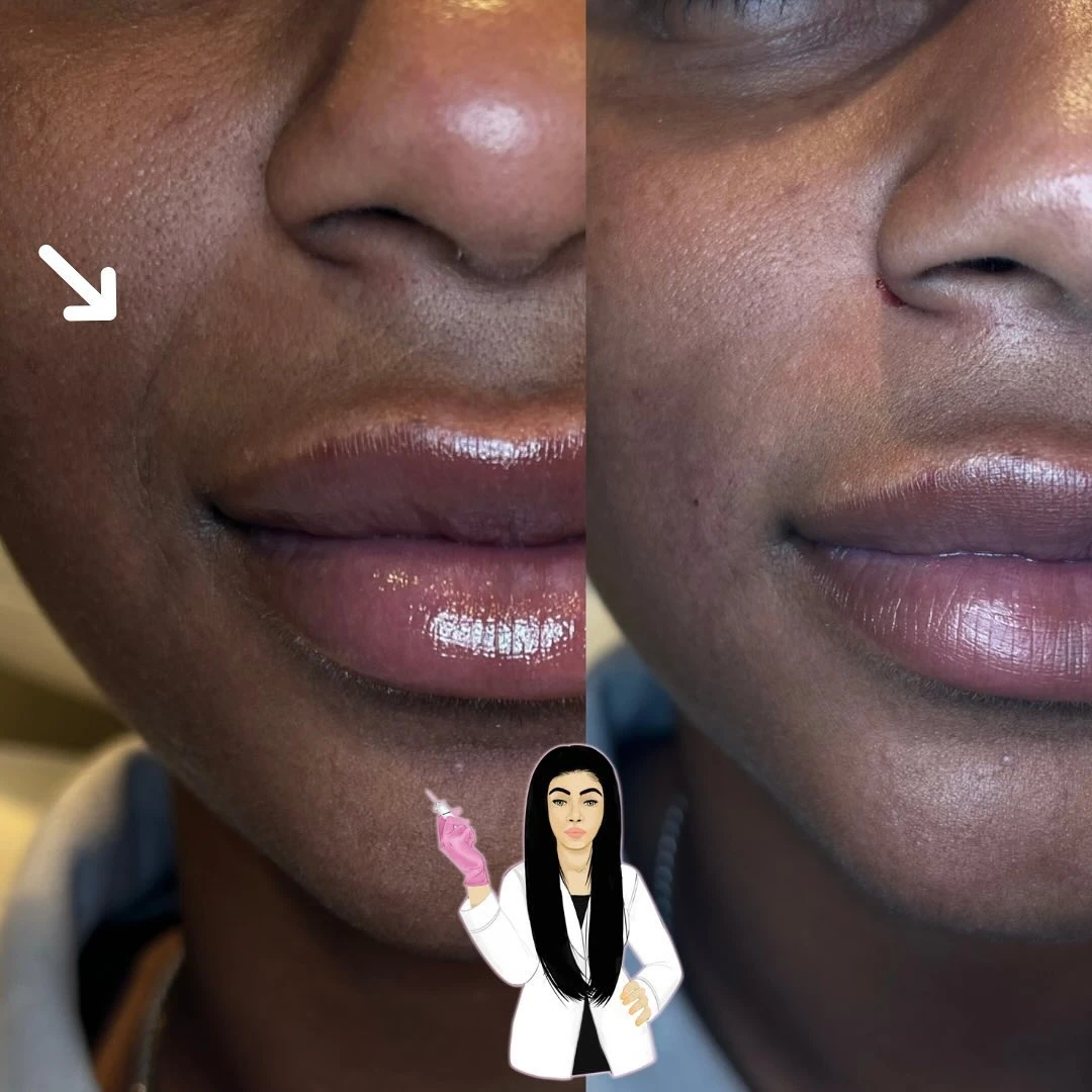 Lip Filler Treatment by Angel Face Injections