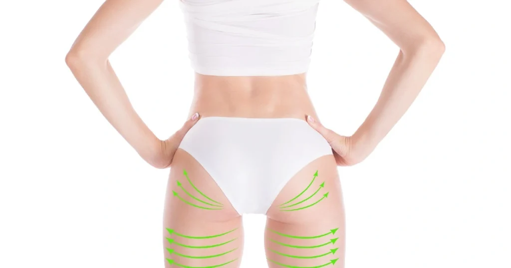 Women receiving Non-Surgical BBL in Stoneham, MA